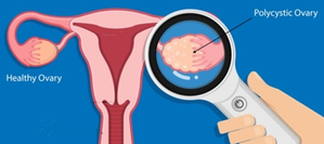 Routine screening key for early detection of ovarian cancer: Experts | Routine screening key for early detection of ovarian cancer: Experts
