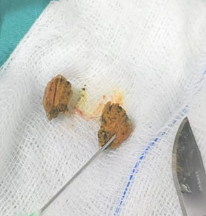 Pune doctors remove turmeric pieces that formed layers in elderly man’s lungs | Pune doctors remove turmeric pieces that formed layers in elderly man’s lungs