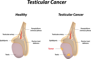 Why young men must be aware of testicular cancer | Why young men must be aware of testicular cancer
