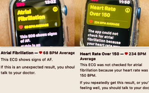 Apple Watch saves Delhi woman's life by alerting abnormal heart rhythm | Apple Watch saves Delhi woman's life by alerting abnormal heart rhythm Apple Watch saves Delhi woman's life by alerting abnormal heart rhythm | Apple Watch saves Delhi woman's life by alerting abnormal heart rhythm