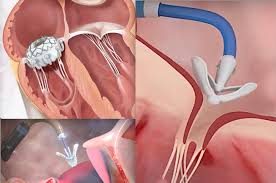 Doctors treat woman’s heart disease using minimally invasive transcatheter clips | Doctors treat woman’s heart disease using minimally invasive transcatheter clips