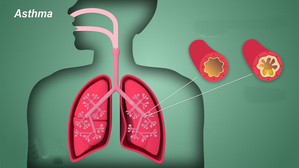 'IDIOT' syndrome hampers asthma treatment: experts | 'IDIOT' syndrome hampers asthma treatment: experts 'IDIOT' syndrome hampers asthma treatment: experts | 'IDIOT' syndrome hampers asthma treatment: experts