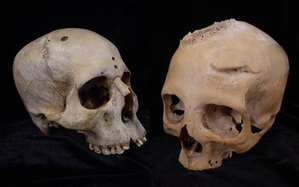 Cut marks on 4,000-yr-old skulls show ancient Egyptians tried to treat cancer | Cut marks on 4,000-yr-old skulls show ancient Egyptians tried to treat cancer Cut marks on 4,000-yr-old skulls show ancient Egyptians tried to treat cancer | Cut marks on 4,000-yr-old skulls show ancient Egyptians tried to treat cancer