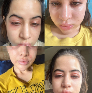 Uorfi Javed clarifies she has ‘major allergies’ and hasn't gone ‘overboard with fillers’ | Uorfi Javed clarifies she has ‘major allergies’ and hasn't gone ‘overboard with fillers’ Uorfi Javed clarifies she has ‘major allergies’ and hasn't gone ‘overboard with fillers’ | Uorfi Javed clarifies she has ‘major allergies’ and hasn't gone ‘overboard with fillers’
