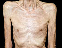 What's 'cancer cachexia' syndrome, a disease behind most patients' death? | What's 'cancer cachexia' syndrome, a disease behind most patients' death? What's 'cancer cachexia' syndrome, a disease behind most patients' death? | What's 'cancer cachexia' syndrome, a disease behind most patients' death?