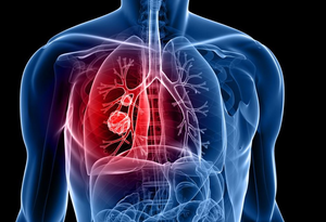 Lung cancer is most common cancer to spread to brain: Experts | Lung cancer is most common cancer to spread to brain: Experts Lung cancer is most common cancer to spread to brain: Experts | Lung cancer is most common cancer to spread to brain: Experts