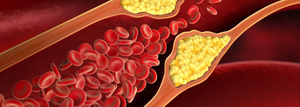 Reduce your bad cholesterol levels to keep Alzheimer’s, dementia at bay | Reduce your bad cholesterol levels to keep Alzheimer’s, dementia at bay Reduce your bad cholesterol levels to keep Alzheimer’s, dementia at bay | Reduce your bad cholesterol levels to keep Alzheimer’s, dementia at bay