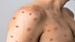 DR Congo to begin Mpox vaccination from October 2 | DR Congo to begin Mpox vaccination from October 2 DR Congo to begin Mpox vaccination from October 2 | DR Congo to begin Mpox vaccination from October 2
