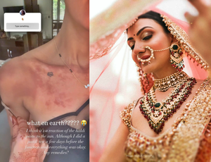 Priyanka Chopra's bhabhi Neelam Upadhyaya suffers burns on her skin | Priyanka Chopra's bhabhi Neelam Upadhyaya suffers burns on her skin Priyanka Chopra's bhabhi Neelam Upadhyaya suffers burns on her skin | Priyanka Chopra's bhabhi Neelam Upadhyaya suffers burns on her skin