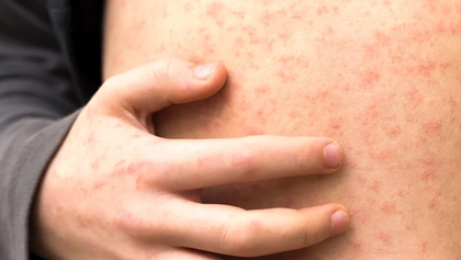 Texas outbreak could upend measles elimination claim by US | Texas outbreak could upend measles elimination claim by US Texas outbreak could upend measles elimination claim by US | Texas outbreak could upend measles elimination claim by US