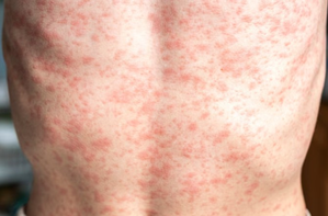 Over 900 measles cases reported in US so far in 2025: CDC | Over 900 measles cases reported in US so far in 2025: CDC Over 900 measles cases reported in US so far in 2025: CDC | Over 900 measles cases reported in US so far in 2025: CDC