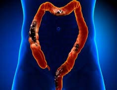 Gene-editing therapy shows promise against advanced colorectal cancer | Gene-editing therapy shows promise against advanced colorectal cancer Gene-editing therapy shows promise against advanced colorectal cancer | Gene-editing therapy shows promise against advanced colorectal cancer