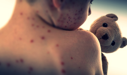 US measles cases top 1,000 in 2025, highest level in 6 years | US measles cases top 1,000 in 2025, highest level in 6 years US measles cases top 1,000 in 2025, highest level in 6 years | US measles cases top 1,000 in 2025, highest level in 6 years