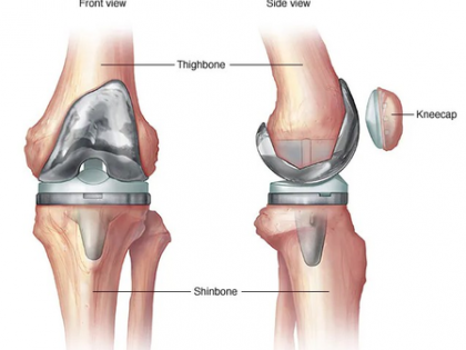 Diabetes may raise infection, blood clot risk post knee replacement surgery: Study | Diabetes may raise infection, blood clot risk post knee replacement surgery: Study Diabetes may raise infection, blood clot risk post knee replacement surgery: Study | Diabetes may raise infection, blood clot risk post knee replacement surgery: Study