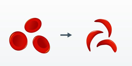 Sickle Cell Disease: India achieves milestone with 6 cr screenings, says Govt | Sickle Cell Disease: India achieves milestone with 6 cr screenings, says Govt