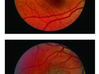 Surgical implant can slow down vision loss caused by blinding eye disease: Study | Surgical implant can slow down vision loss caused by blinding eye disease: Study