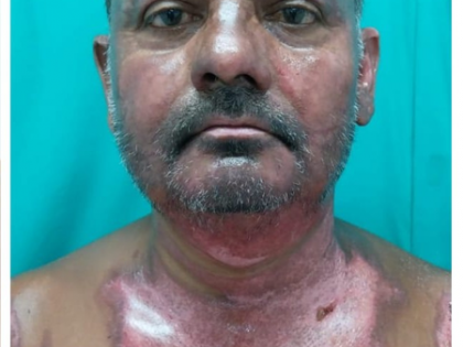 Nagaland electrician’s remarkable recovery under Army care after severe burn injury | Nagaland electrician’s remarkable recovery under Army care after severe burn injury Nagaland electrician’s remarkable recovery under Army care after severe burn injury | Nagaland electrician’s remarkable recovery under Army care after severe burn injury