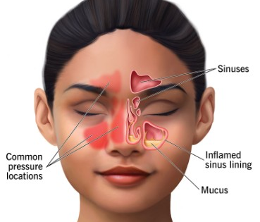 Surgery more effective in treating chronic sinus than antibiotics: Study | Surgery more effective in treating chronic sinus than antibiotics: Study