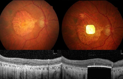 New retinal implant restores vision in patients with irreversible blindness | New retinal implant restores vision in patients with irreversible blindness New retinal implant restores vision in patients with irreversible blindness | New retinal implant restores vision in patients with irreversible blindness