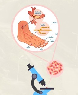 Nagaland University researchers find plant compound to treat diabetic wound, foot ulcers | Nagaland University researchers find plant compound to treat diabetic wound, foot ulcers Nagaland University researchers find plant compound to treat diabetic wound, foot ulcers | Nagaland University researchers find plant compound to treat diabetic wound, foot ulcers
