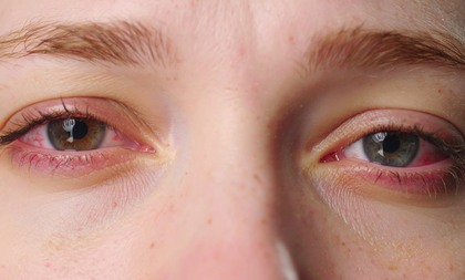 City doctors report 50 pc rise in eye problems as smog continues to engulf Delhi | City doctors report 50 pc rise in eye problems as smog continues to engulf Delhi City doctors report 50 pc rise in eye problems as smog continues to engulf Delhi | City doctors report 50 pc rise in eye problems as smog continues to engulf Delhi