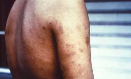 Maha govt to launch statewide drive against leprosy from November 17 | Maha govt to launch statewide drive against leprosy from November 17 Maha govt to launch statewide drive against leprosy from November 17 | Maha govt to launch statewide drive against leprosy from November 17