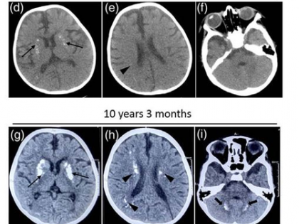 Indian researchers find rare gene mutation linked to recurrent neurological decline in kids | Indian researchers find rare gene mutation linked to recurrent neurological decline in kids