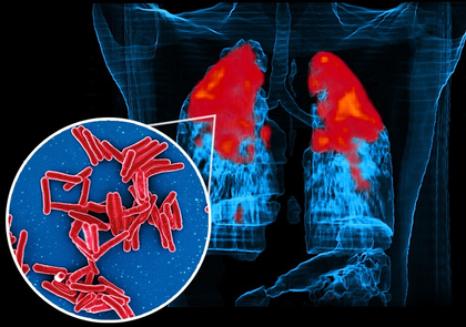 IIT Bombay study shows how TB bacteria shield themselves from antibiotics, stay alive longer | IIT Bombay study shows how TB bacteria shield themselves from antibiotics, stay alive longer IIT Bombay study shows how TB bacteria shield themselves from antibiotics, stay alive longer | IIT Bombay study shows how TB bacteria shield themselves from antibiotics, stay alive longer