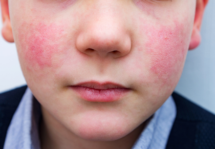 Common parvovirus B19 can cause serious encephalitis: AIIMS Bhopal | Common parvovirus B19 can cause serious encephalitis: AIIMS Bhopal Common parvovirus B19 can cause serious encephalitis: AIIMS Bhopal | Common parvovirus B19 can cause serious encephalitis: AIIMS Bhopal