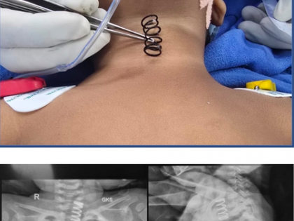 AIIMS doctors remove 2-inch-long metal spring from 14-month-old's food pipe | AIIMS doctors remove 2-inch-long metal spring from 14-month-old's food pipe AIIMS doctors remove 2-inch-long metal spring from 14-month-old's food pipe | AIIMS doctors remove 2-inch-long metal spring from 14-month-old's food pipe
