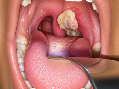 Australia's diphtheria outbreak spreads beyond Northern Territory | Australia's diphtheria outbreak spreads beyond Northern Territory Australia's diphtheria outbreak spreads beyond Northern Territory | Australia's diphtheria outbreak spreads beyond Northern Territory