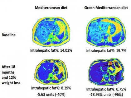 Green med diet cuts non-alcoholic fatty liver disease by half: Study | Green med diet cuts non-alcoholic fatty liver disease by half: Study