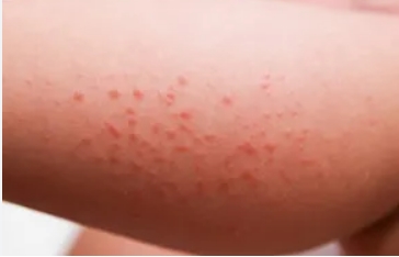Childhood allergies skin, lungs begin in our gut: Study | Childhood allergies skin, lungs begin in our gut: Study Childhood allergies skin, lungs begin in our gut: Study | Childhood allergies skin, lungs begin in our gut: Study