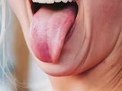Tongue reconstructed with microvascular surgery in UP hospital | Tongue reconstructed with microvascular surgery in UP hospital