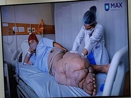 Surgery helps Delhi man bedridden with 45-kg elephantiasis leg walk for first time in 10 years | Surgery helps Delhi man bedridden with 45-kg elephantiasis leg walk for first time in 10 years