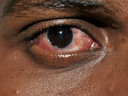 Conjunctivitis cases register 50% increase in a week in Lucknow | Conjunctivitis cases register 50% increase in a week in Lucknow Conjunctivitis cases register 50% increase in a week in Lucknow | Conjunctivitis cases register 50% increase in a week in Lucknow