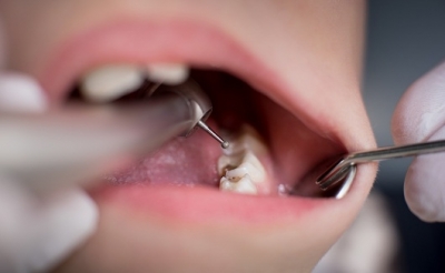Study finds why tooth enamel damage occurs in celiac disease patients | Study finds why tooth enamel damage occurs in celiac disease patients Study finds why tooth enamel damage occurs in celiac disease patients | Study finds why tooth enamel damage occurs in celiac disease patients