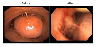 Hyd doctors use endoscopic method to remove tumor blocking patient's respiratory tract | Hyd doctors use endoscopic method to remove tumor blocking patient's respiratory tract