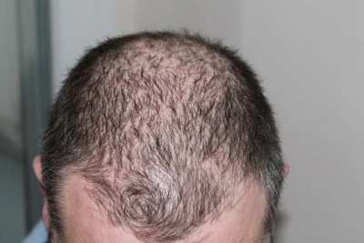 Hair loss is new post Covid complication: Doctors | Hair loss is new post Covid complication: Doctors