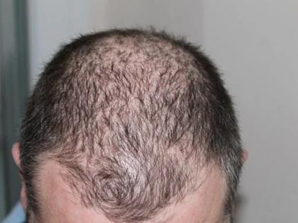 Rare gene variants causing hereditary hair loss in men identified | Rare gene variants causing hereditary hair loss in men identified Rare gene variants causing hereditary hair loss in men identified | Rare gene variants causing hereditary hair loss in men identified