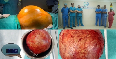 Doctors at Hyderabad hospital remove football-sized kidney tumour | Doctors at Hyderabad hospital remove football-sized kidney tumour Doctors at Hyderabad hospital remove football-sized kidney tumour | Doctors at Hyderabad hospital remove football-sized kidney tumour
