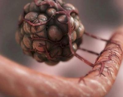 Researchers find genetic fingerprints to predict efficacy of immunotherapy | Researchers find genetic fingerprints to predict efficacy of immunotherapy Researchers find genetic fingerprints to predict efficacy of immunotherapy | Researchers find genetic fingerprints to predict efficacy of immunotherapy