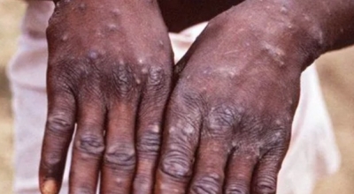 12-yr-old K'taka girl develops monkeypox symptoms | 12-yr-old K'taka girl develops monkeypox symptoms