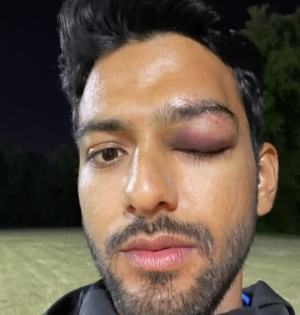 Former India U-19 star Unmukt Chand suffers serious eye injury; says grateful to have survived a possible disaster | Former India U-19 star Unmukt Chand suffers serious eye injury; says grateful to have survived a possible disaster