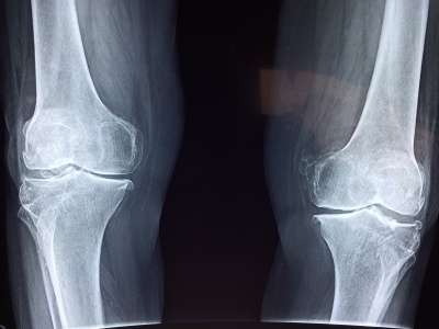 Octagenarian undergoes successful total knee replacement surgery | Octagenarian undergoes successful total knee replacement surgery