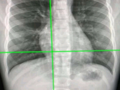 New AI tool can detect Covid infection from chest X-rays 98% accuracy | New AI tool can detect Covid infection from chest X-rays 98% accuracy