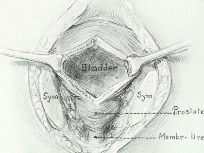 Individualised physical therapy after prostate surgery can reduce incontinence, pain | Individualised physical therapy after prostate surgery can reduce incontinence, pain