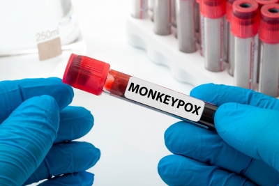US monkeypox case tally soon to outpace other nations: Report | US monkeypox case tally soon to outpace other nations: Report