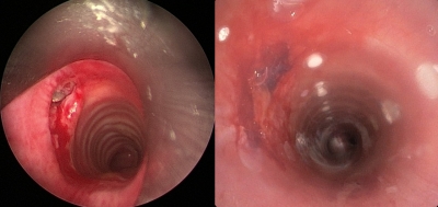 SGPGIMS doctors in Lucknow perform rare bronchoscopic removal of bullet | SGPGIMS doctors in Lucknow perform rare bronchoscopic removal of bullet