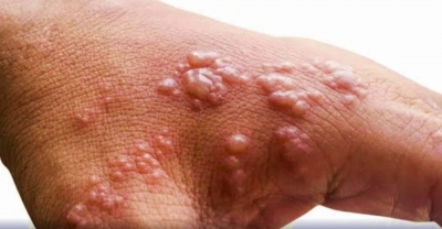 Suspected case of monkeypox in Patna | Suspected case of monkeypox in Patna